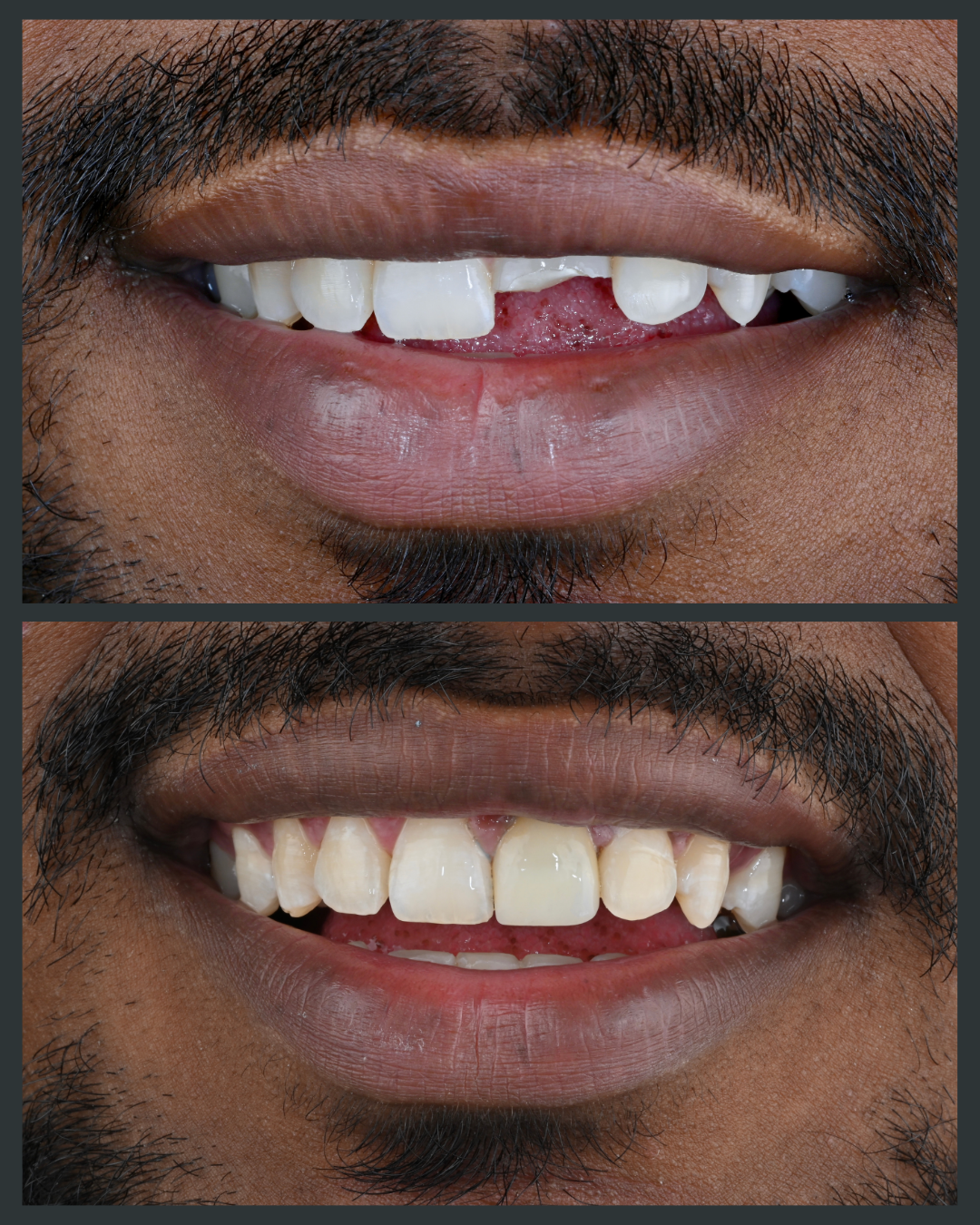 Illustration of chipped or cracked teeth