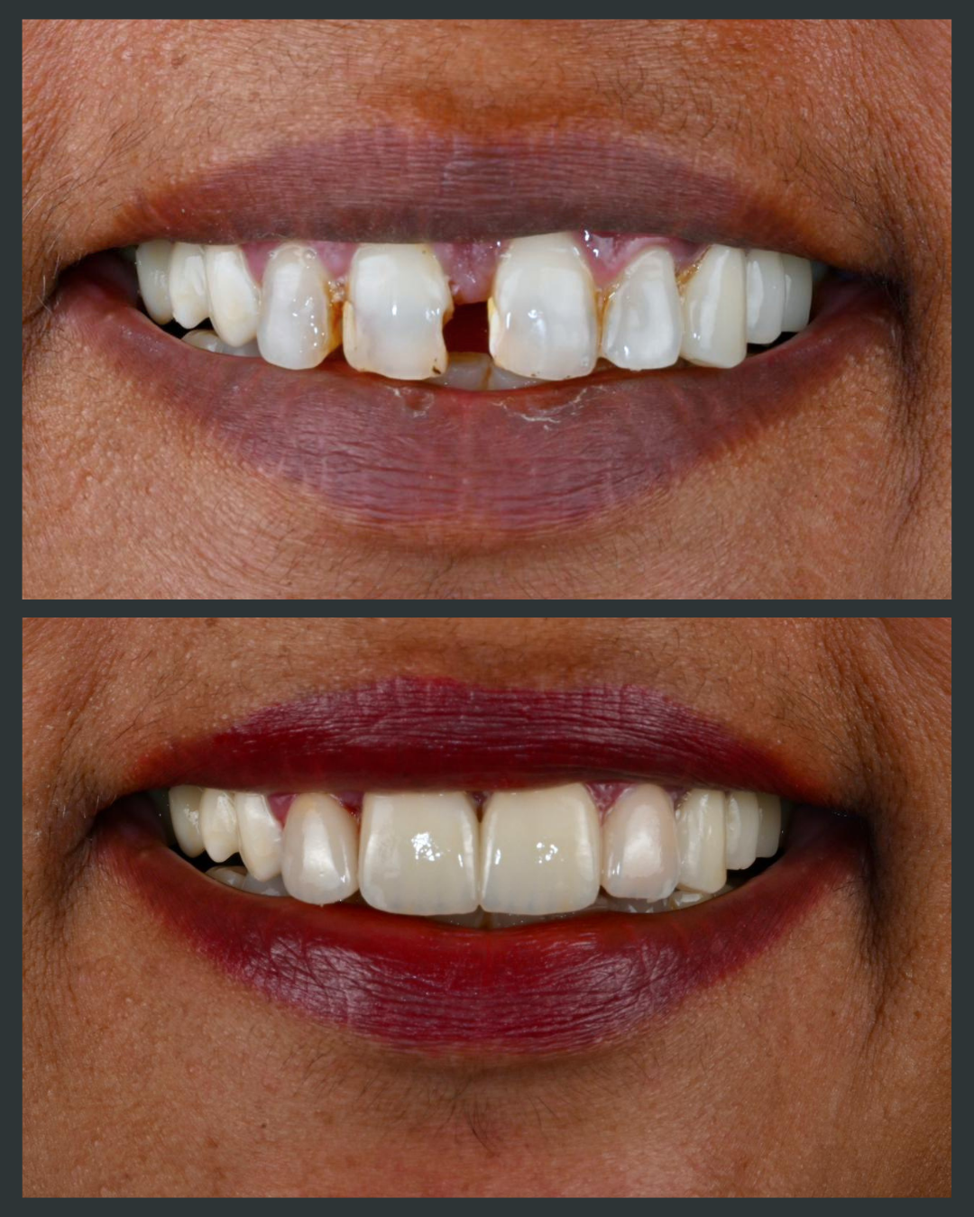 Illustration of gaps between teeth