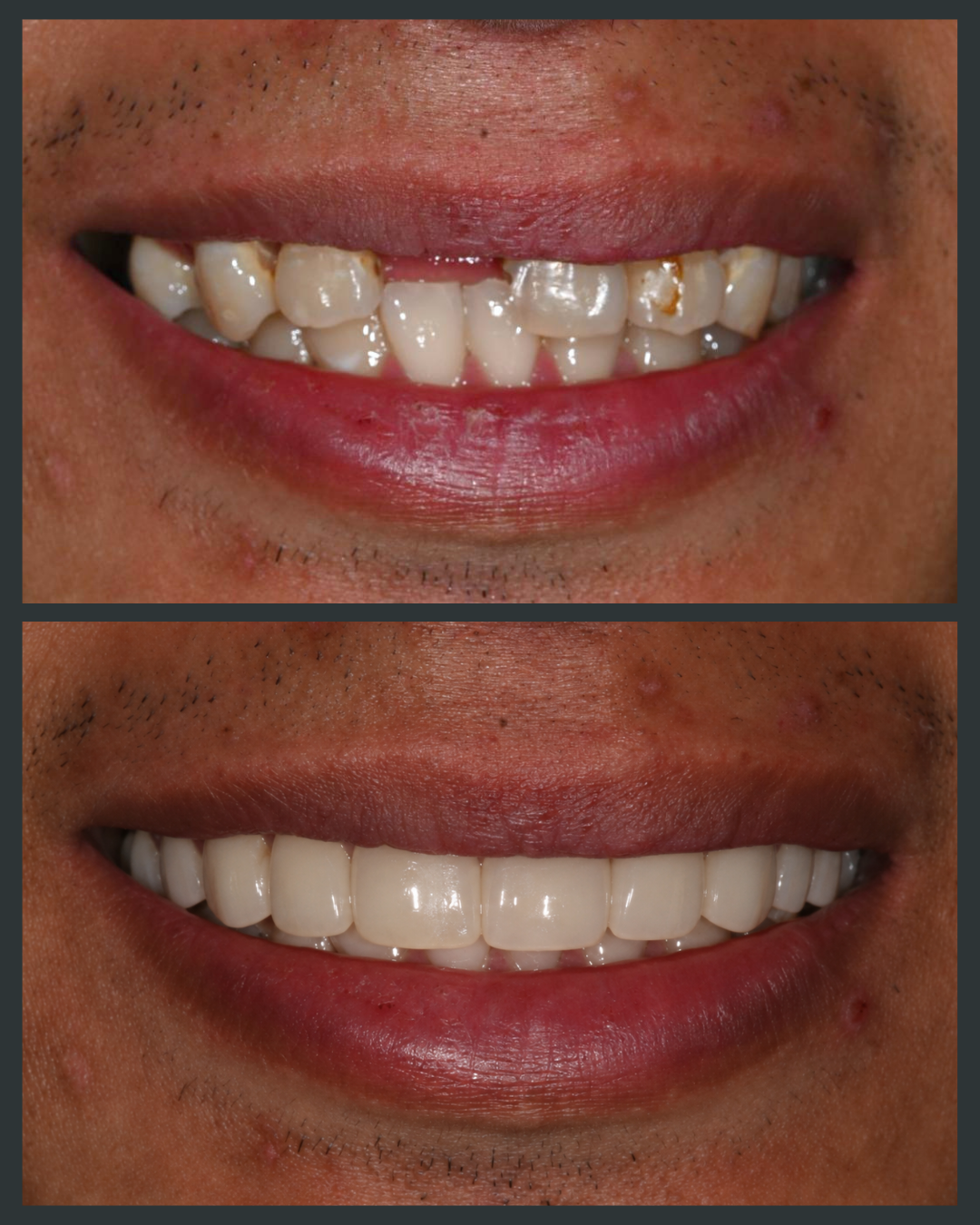 Veneers Before & After Result 1 at Floss-it Dental Clinic