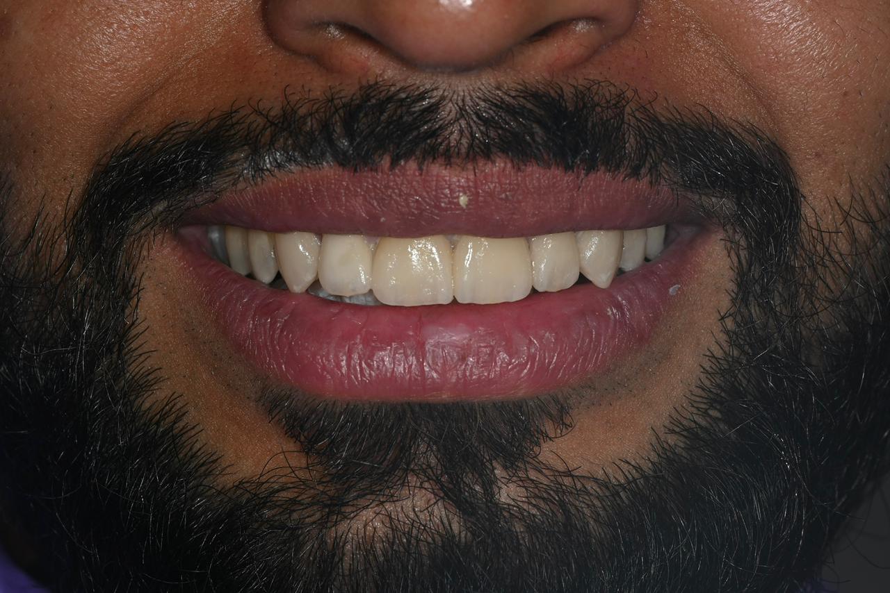 Case 12 after veneers treatment