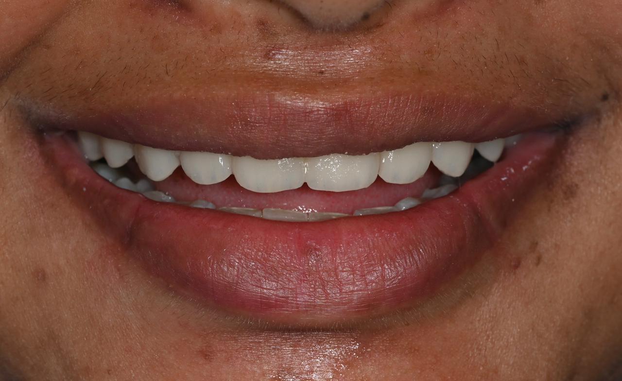 Case 3 after veneers treatment