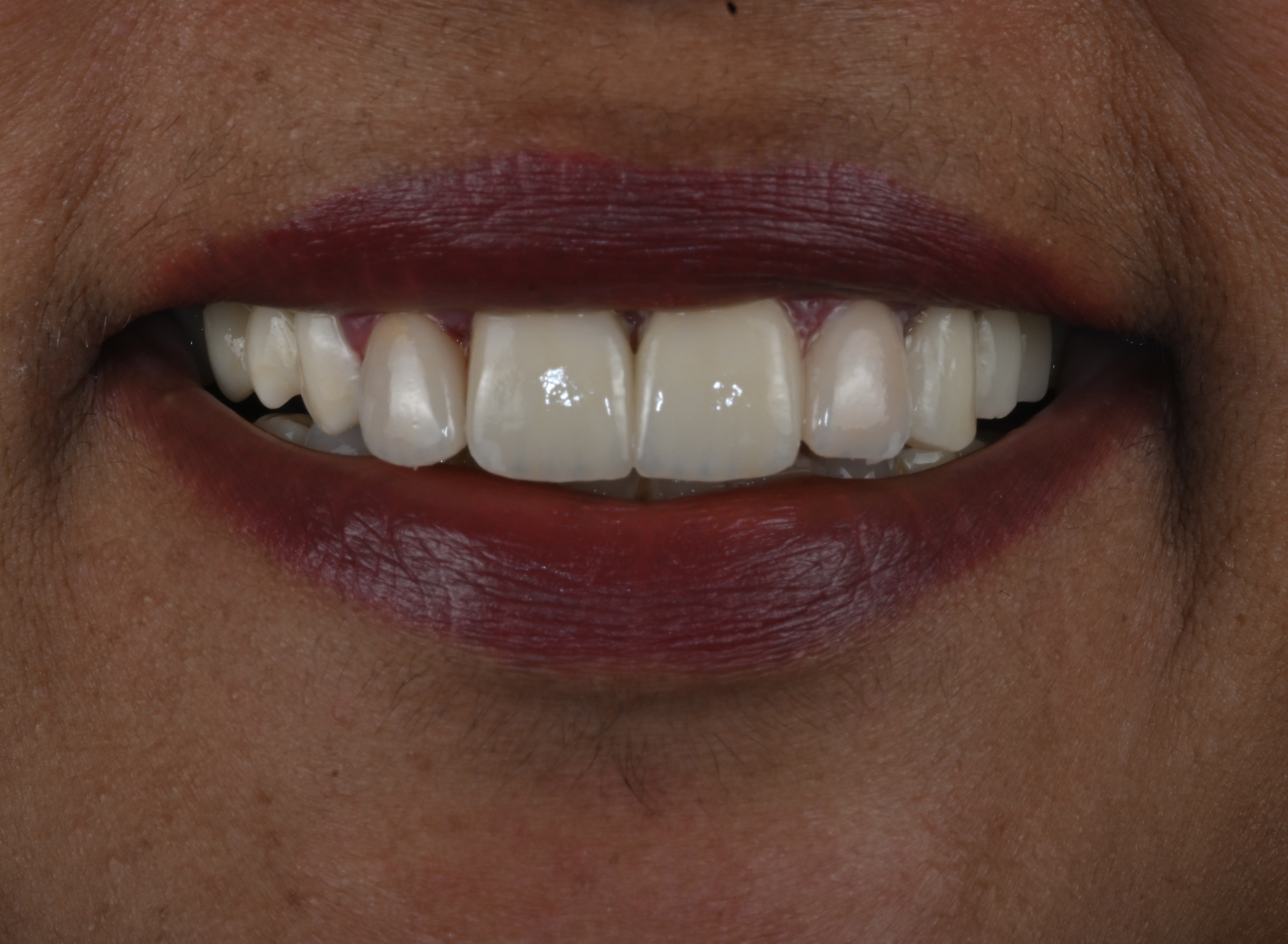 Case 5 after veneers treatment