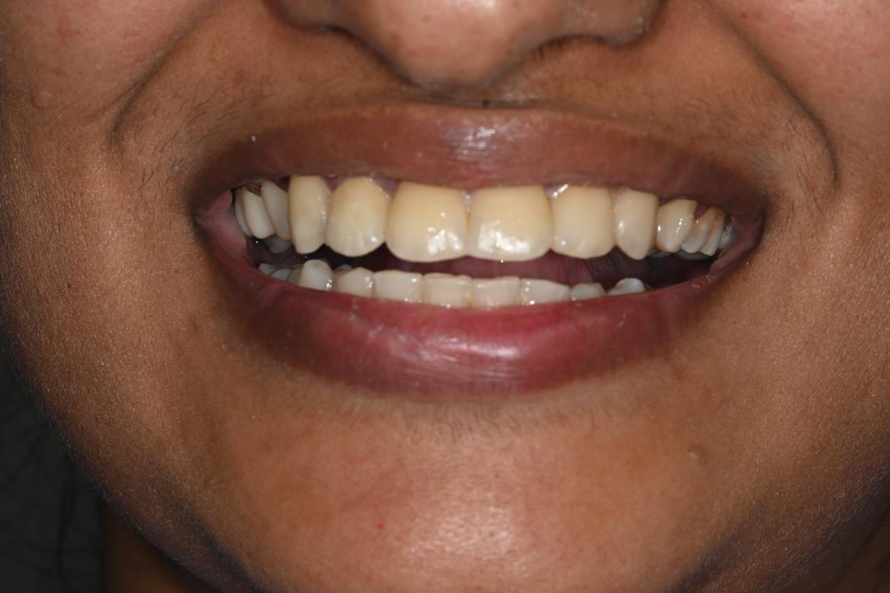 Case 6 after veneers treatment