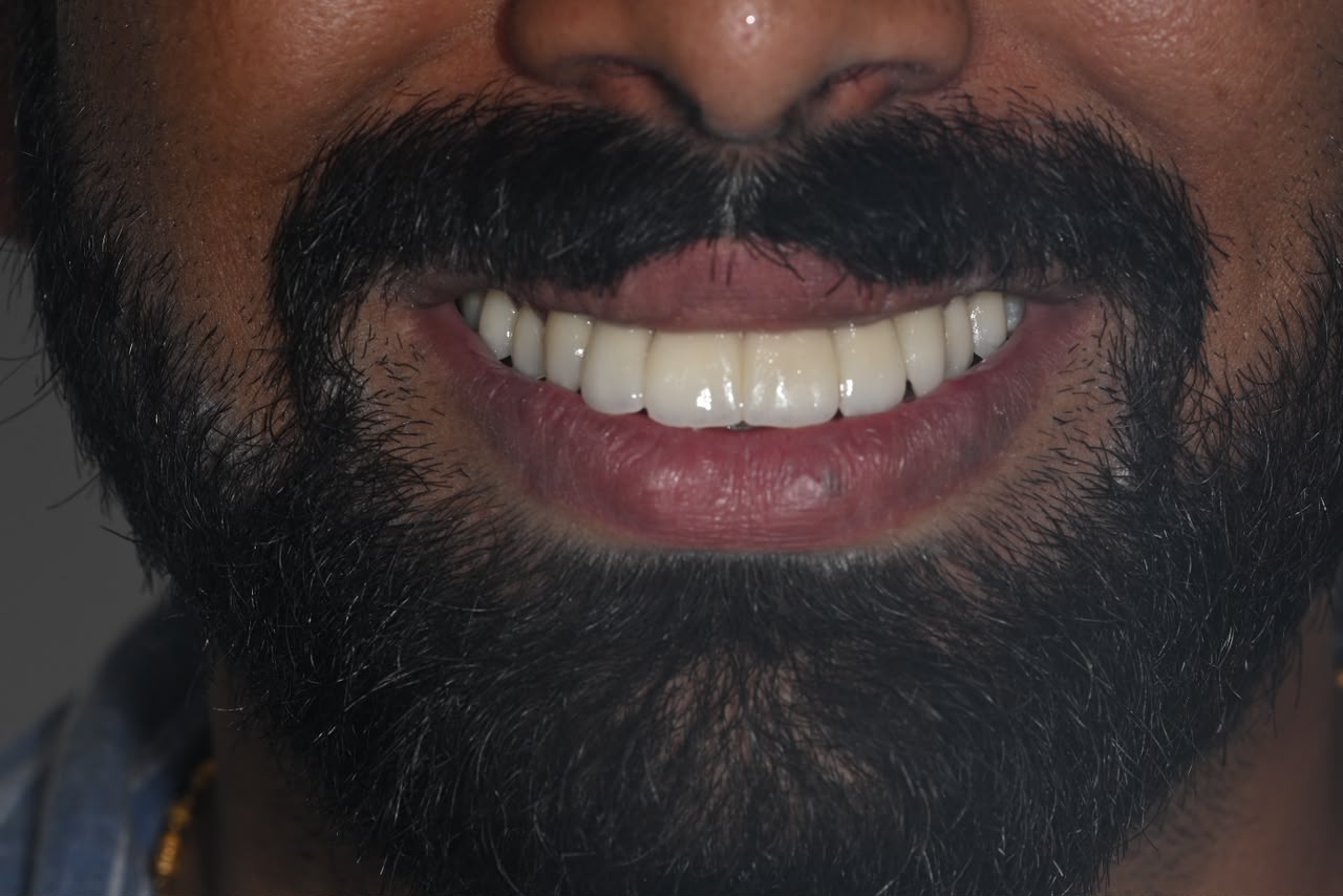 Case 7 after veneers treatment
