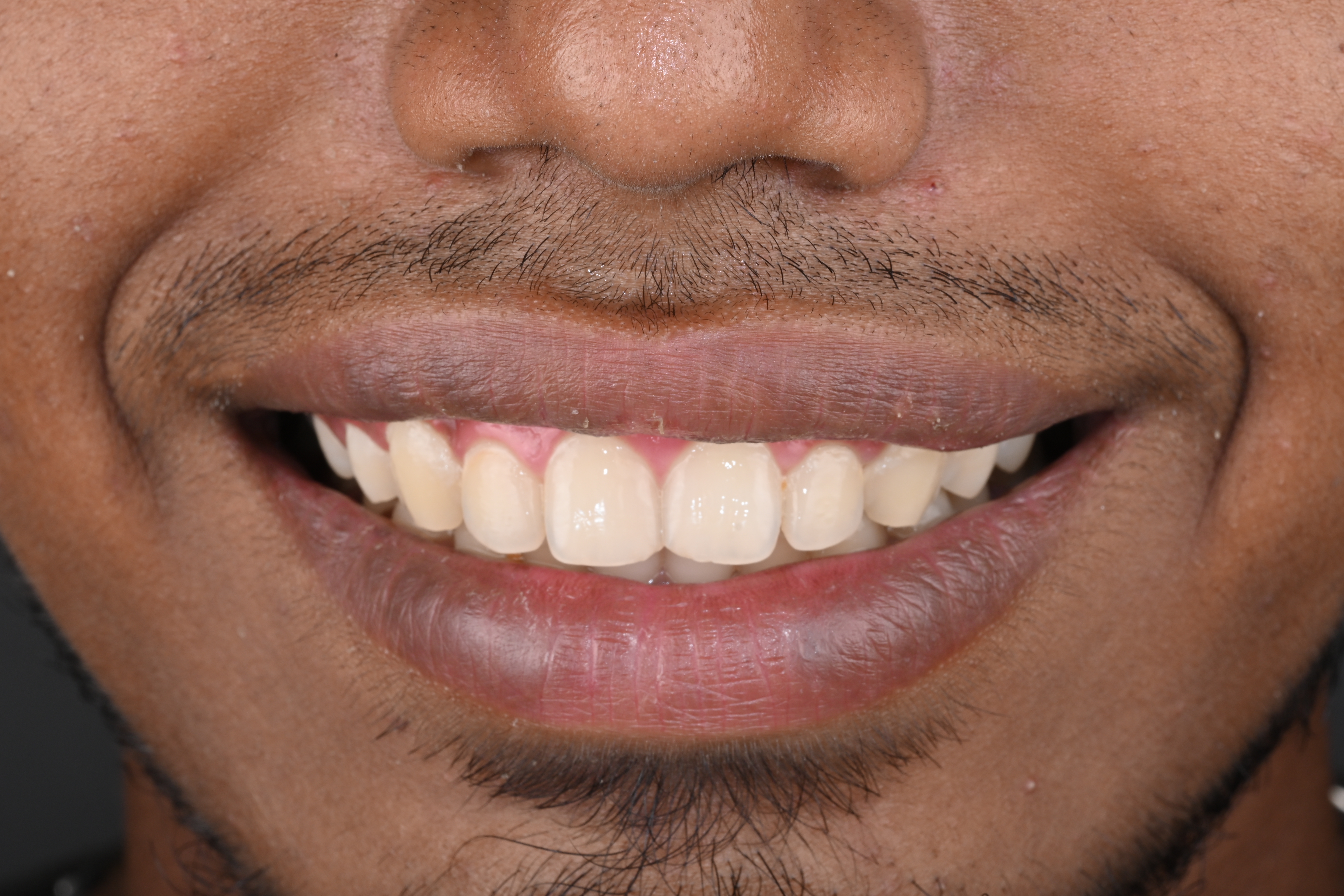 Case 8 after veneers treatment
