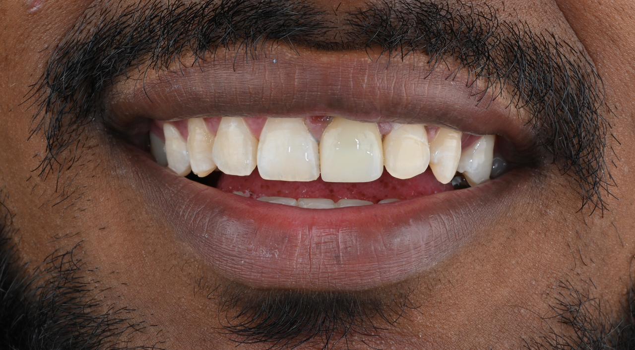 Case 9 after veneers treatment