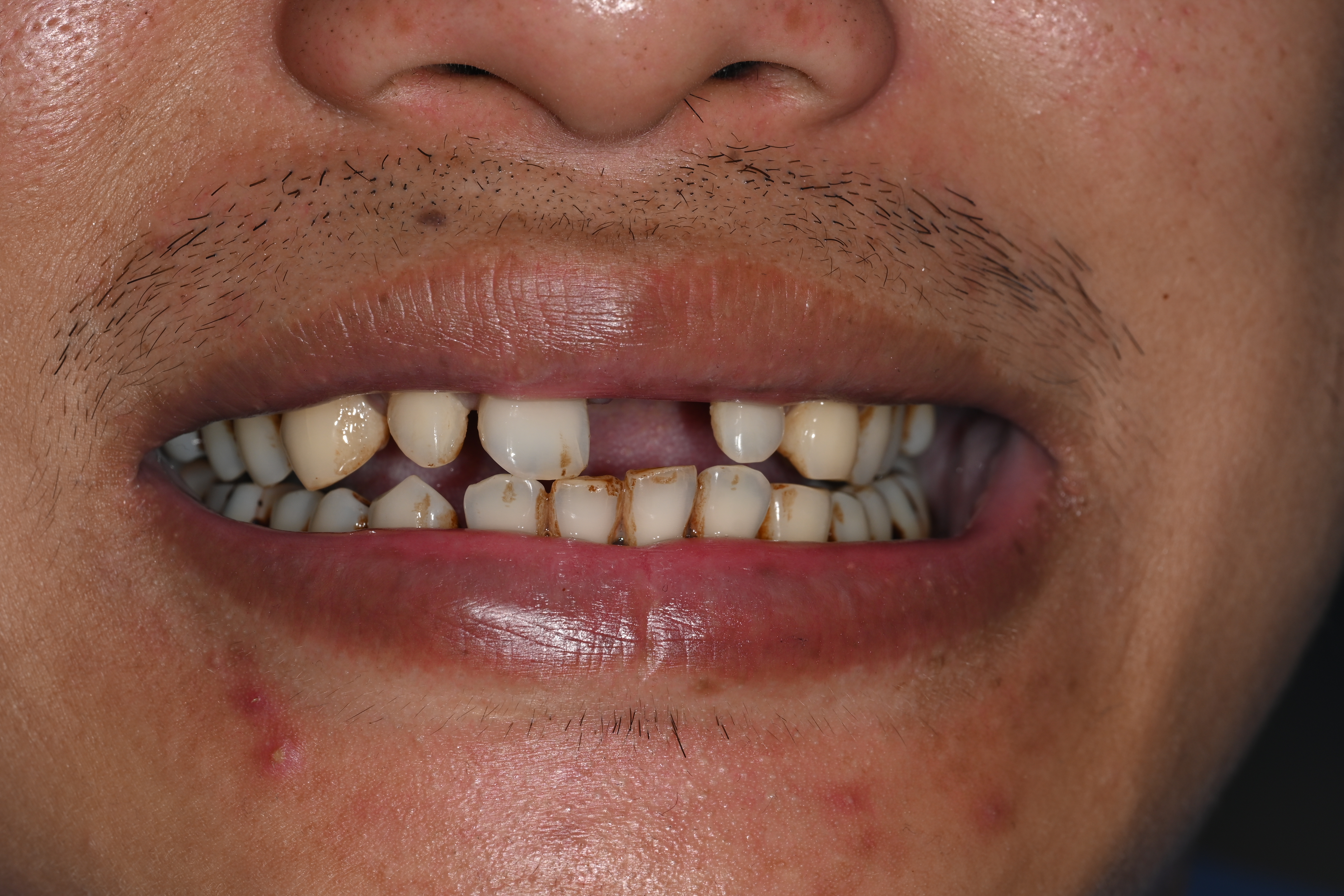 Case 11 before veneers treatment