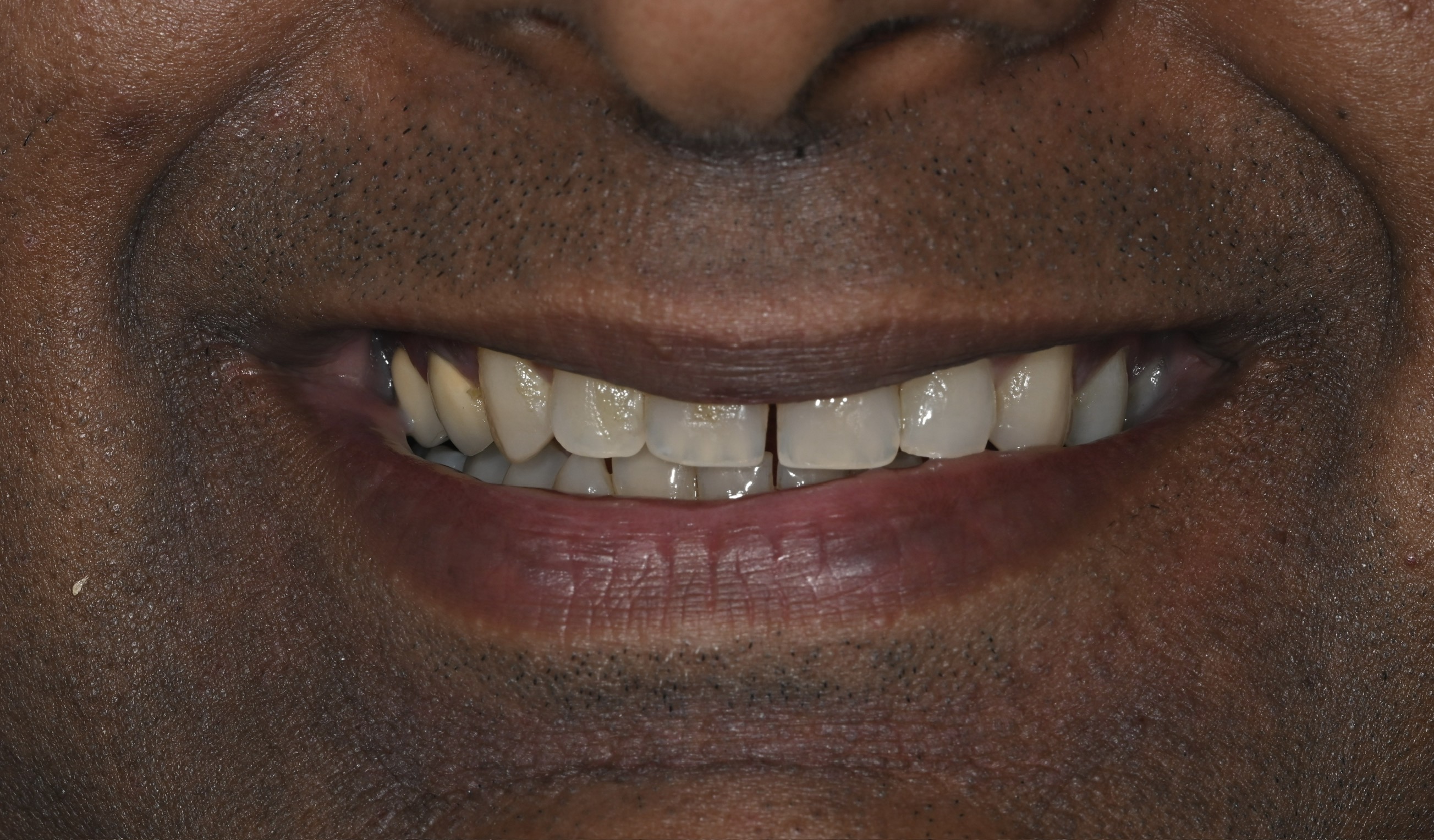 Case 2 before veneers treatment