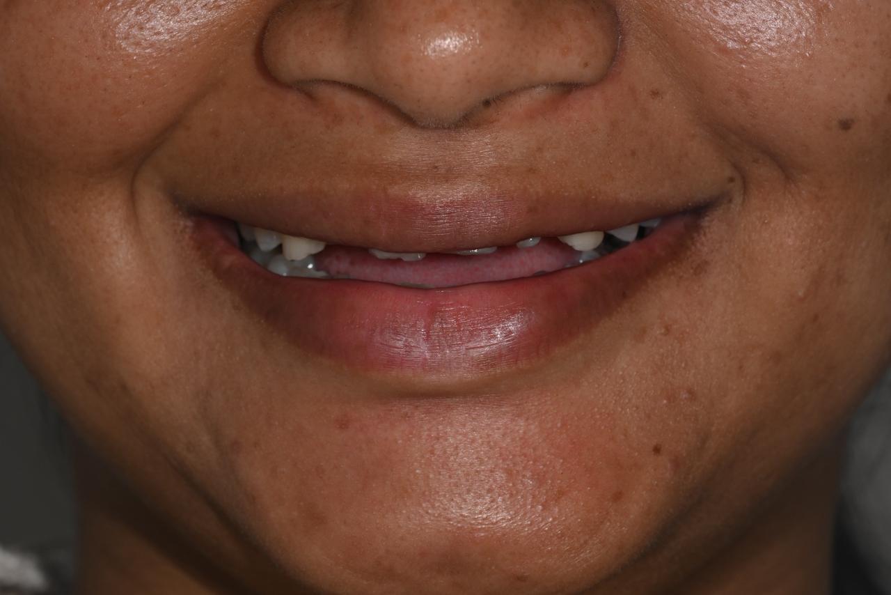 Case 3 before veneers treatment